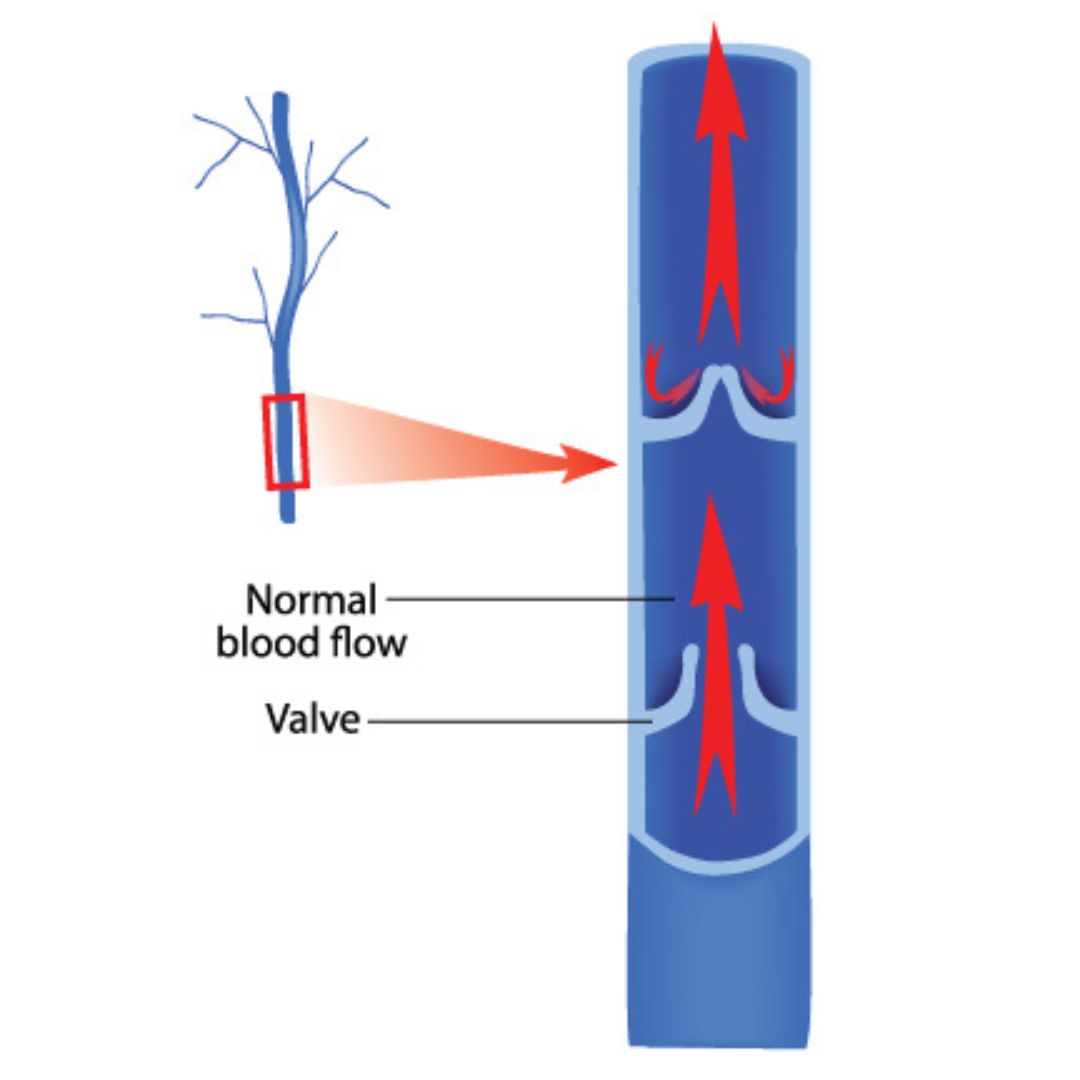 Natural blood return