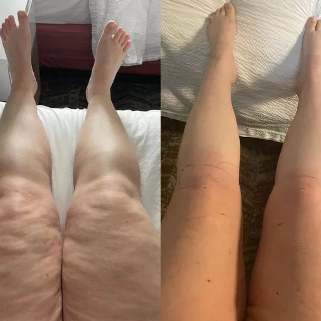 Comfort for swollen legs