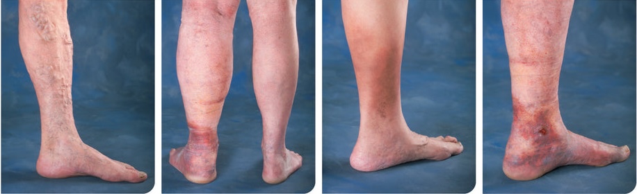 Lower legs with different levels of swelling