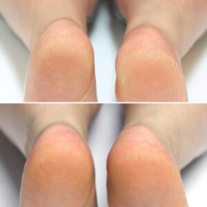 Moisturizing Heel Socks - Heel - Image 4