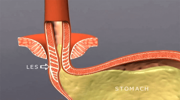 Nocturnal reflux: Acid backs up into the esophagus when lying down