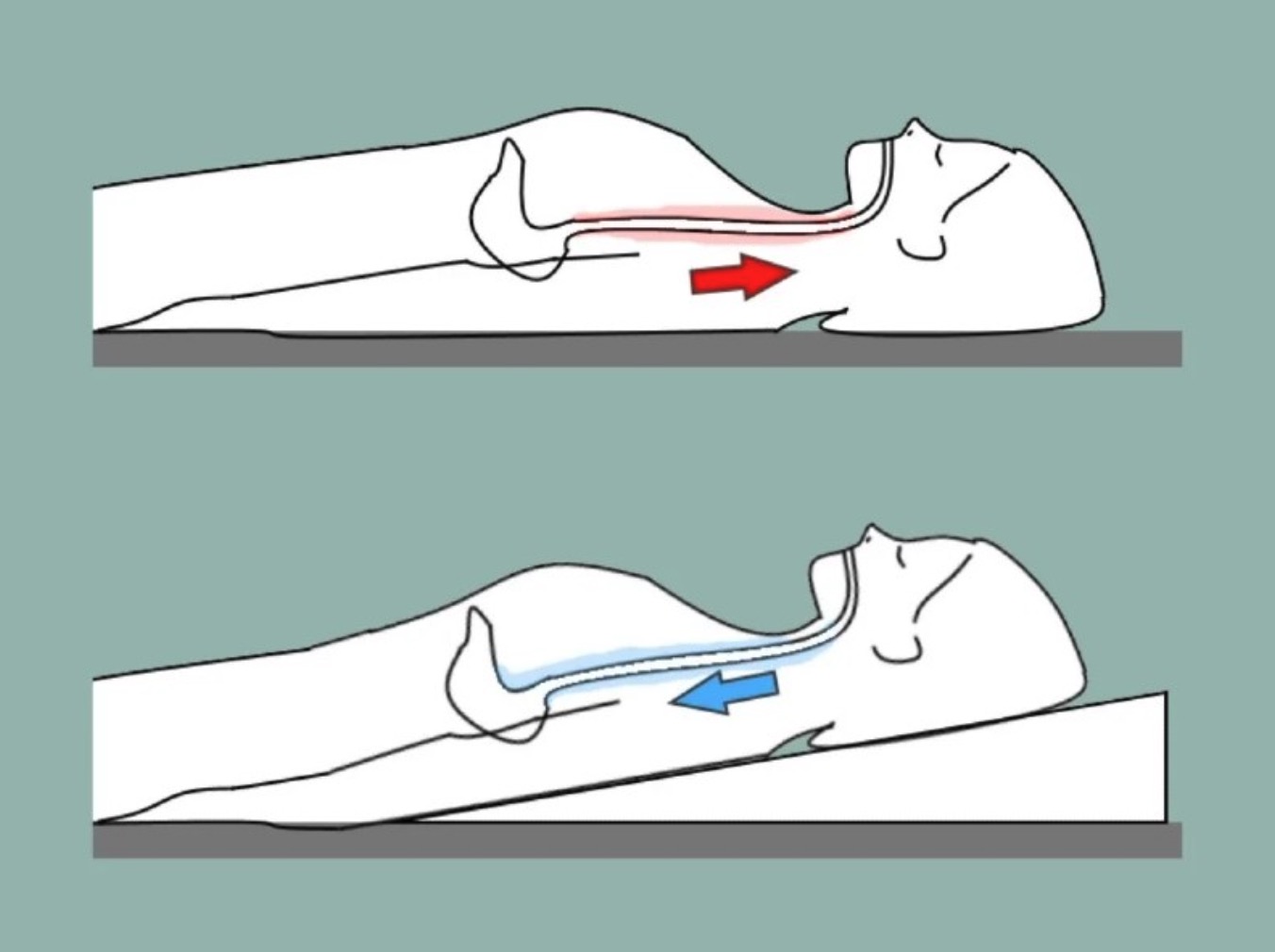 In an upright position, gravity prevents acid from returning to the esophagus